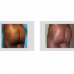 buttock-augmentation-with-fat-injections-indianapolis-dr-barry-eppley