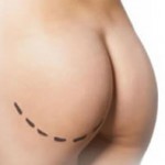 buttock-enhancement-surgery-indianapolis-dr-barry-eppley1