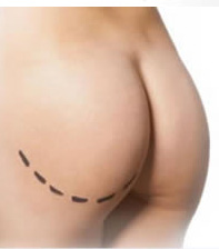 Buttock Enhancement Surgery