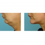 chin-implant-indianapolis-dr-barry-eppley