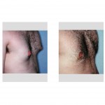 gynecomastia-reduction-open-excision-indianapolis-dr-barry-eppley