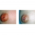 inverted-nipple-repair-indianapolis-dr-barry-eppley
