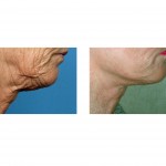 limited-facelift-indianapolis-dr-barry-eppley