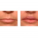 lip-advancement-surgery-indianapolis-dr-barry-eplpey1