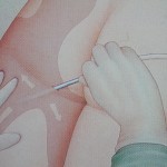 liposuction-indianapolis-dr-barry-eppley2
