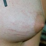 stretch-marks-indianapolis-dr-barry-eppley
