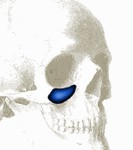 tear-trough-implants-dr-barry-eppley-indianapolis