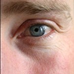tear-trough-implants-indianapolis-dr-barry-eppley