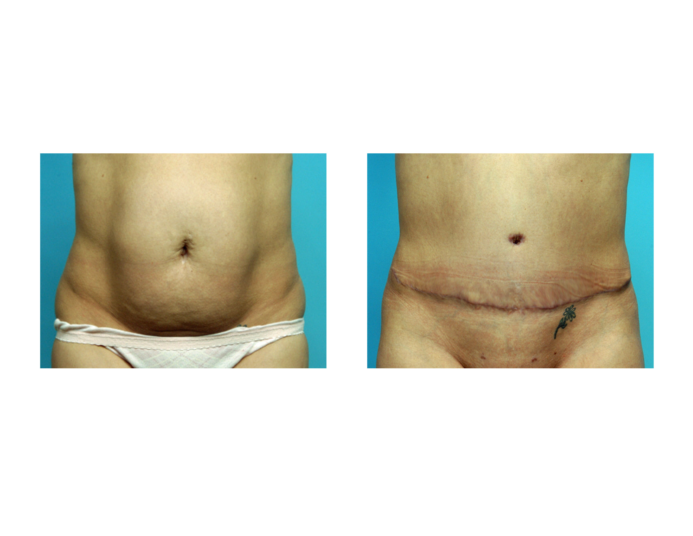Tummy Tuck After Baby