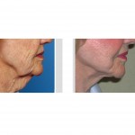 facelift-in-indianapolis-dr-barry-eppley