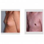 gynecomastia-reduction-liposuction-indianapolis-dr-barry-eppley