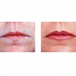 laser-resurfacing-for-lip-wrinkles-indianapolis-dr-barry-eppley