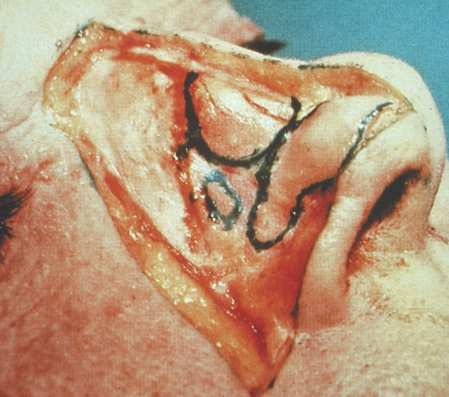 Nasal Dorsum Anatomy