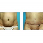 tummy-tuck-indianapolis-dr-barry-eppley