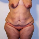 body-contouring-after-massive-weight-loss-dr-barry-eppley-indianapolis7