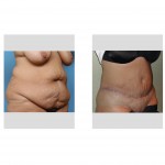 body-contouring-after-massive-weight-loss-indianapolis-dr-barry-eppley4