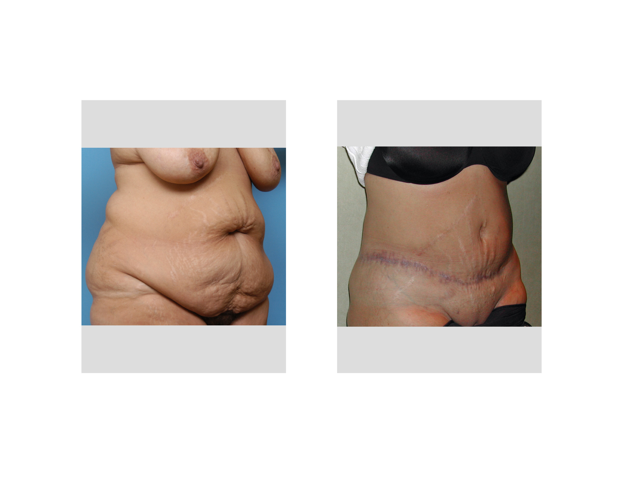 Fastest Weight Loss Without Pills Gluten Free Weight Loss Pills