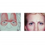 botox-injections-dr-barry-eppley-indianapolis