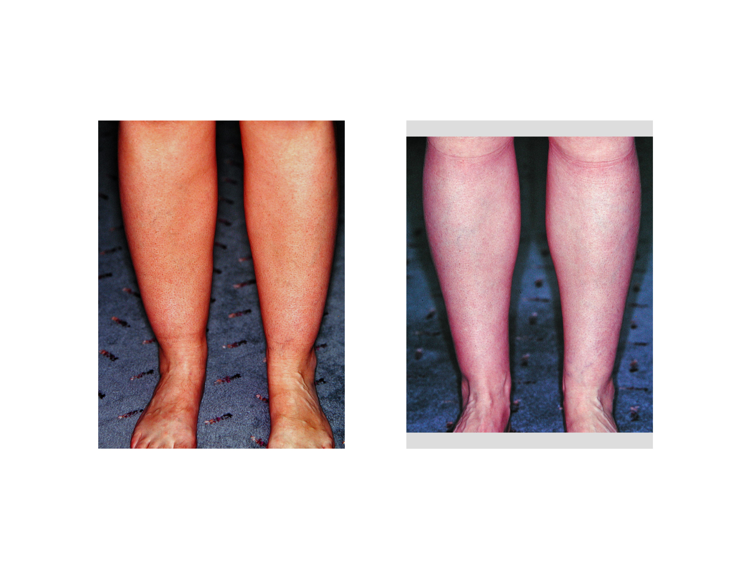 calf lipo