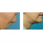 facelift-dr-barry-eppley-indianapolis1