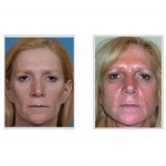fat-injections-for-facial-enhancement-indianapolis-dr-barry-eppley