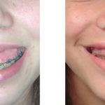 gummy-smile-correction-dr-barry-eppley-indianapolis