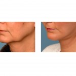 jowlift-limited-facelift-dr-barry-eppley-indianapolis