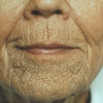 lip-wrinkle-treatments-indianapolis-dr-barry-eppley