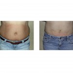 liposuction-indianapolis-dr-barry-eppley1