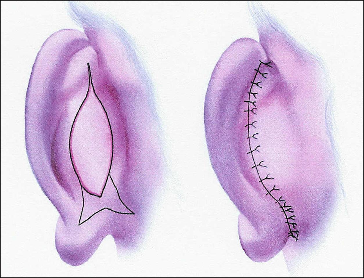 Otoplasty Ear Setback Indianapolis Dr Barry Eppley1 Explore Plastic