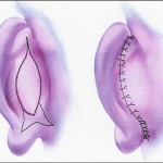 otoplasty-ear-setback-indianapolis-dr-barry-eppley3