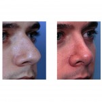 rhinoplasty-nosejob-dr-barry-eppley-indianapolis