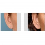 split-earlobe-repair-dr-barry-eppley-indianapolis