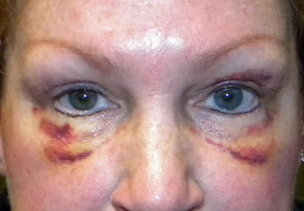 What is the recovery time after eyelid surgery?