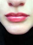chin-surgery-dr-barry-eppley-indianapolis1