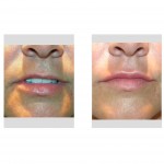 injectable-fillers-thin-lips-dr-barry-eppley-indianapolis