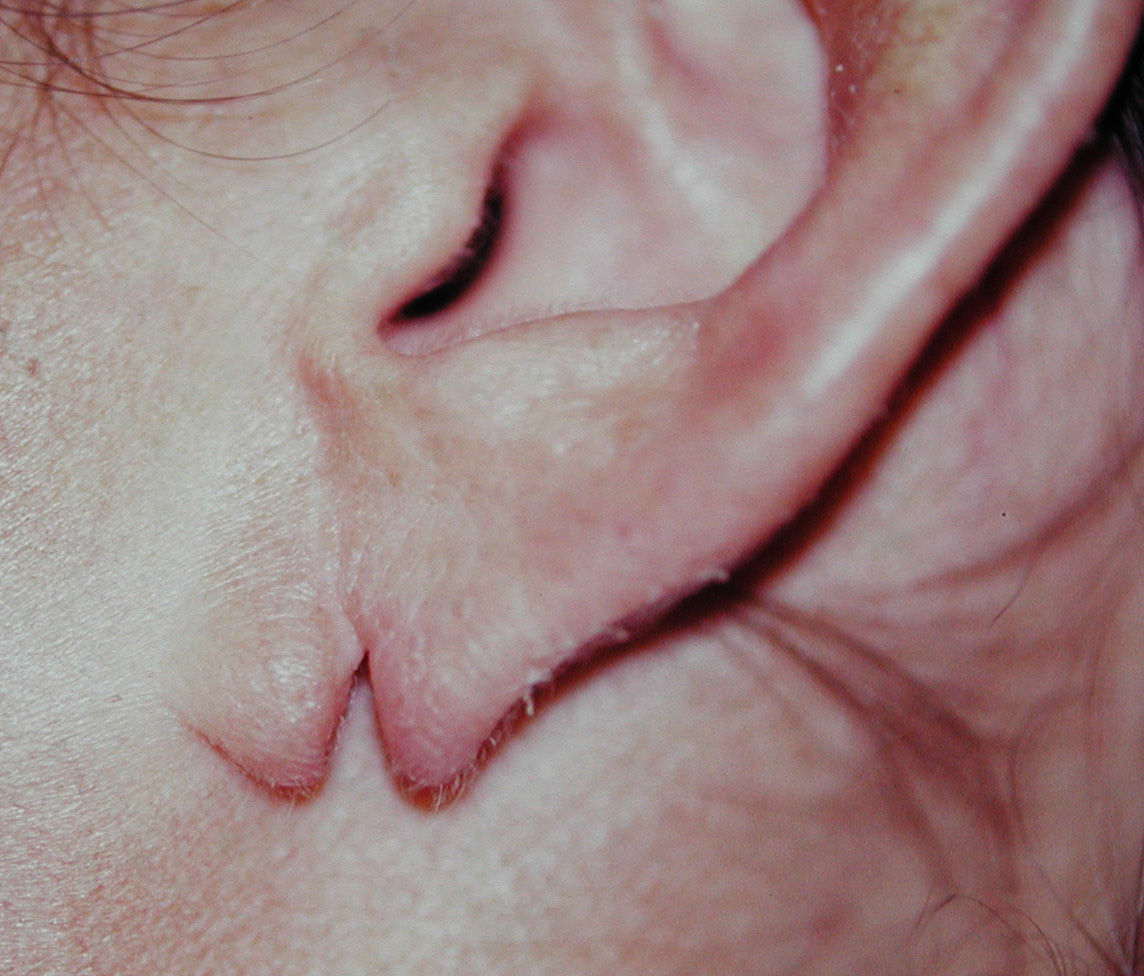 torn-earlobe-repair-before.jpg