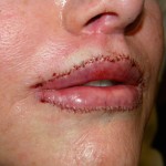 lip-advancements-dr-barry-eppley-indianapolis