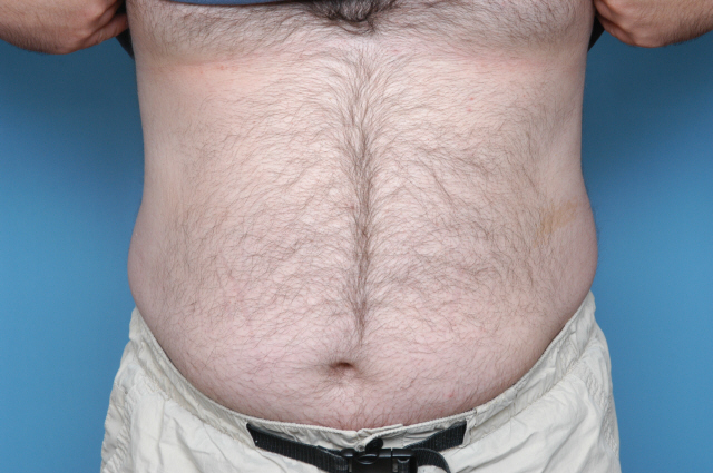 male pubic liposuction pictures