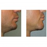 chin-lengthening-dr-barry-eppley-indianapolis