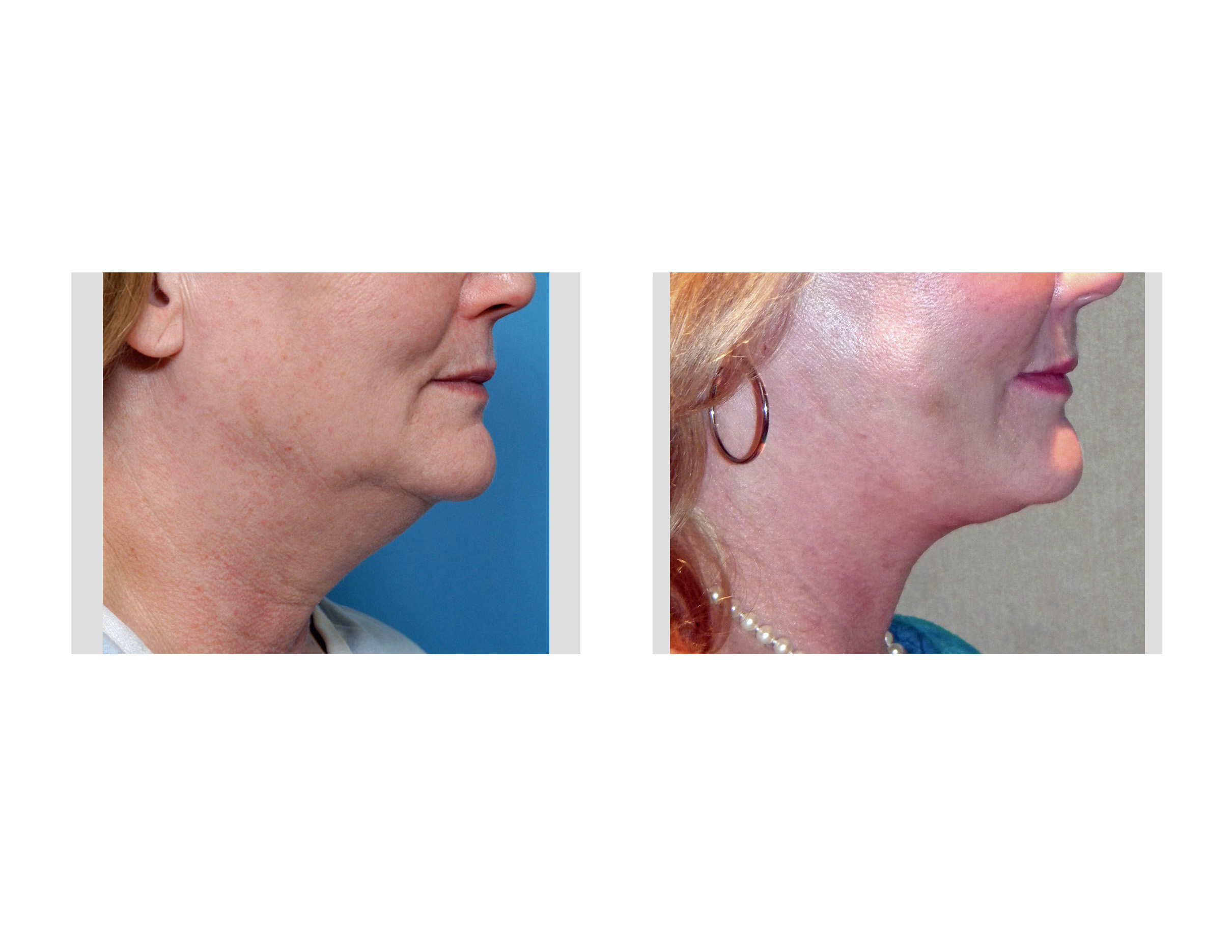 Facelifts and their Recovery