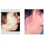 microtia-ear-reconstruction-dr-barry-eppley-indianapolis1