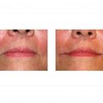 corner-of-mouth-lift-immediate-results-dr-barry-eppley-indianapolis
