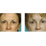 midface-lift-cheek-lift-indianapolis-dr-barry-eppley