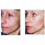 midface-lift-dr-barry-eppley-indianapolis2