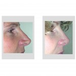rhinoplasty-long-nose-correction-dr-barry-eppley-indianapolis