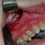 zygomatic-osteotomy-dr-barry-eppley-indianapolis