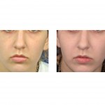 zygomatic-osteotomy-fracture-correction-dr-barry-eppley-indianapolis