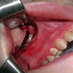 zygomatic-osteotomy-with-plate-fixation-dr-barry-eppley-indianapolis