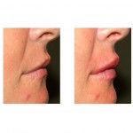 bigger-lips-with-injectable-fillers-dr-barry-eppley-indianapolis